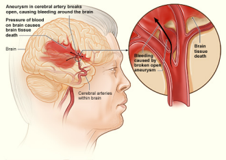 hemorrhagic stroke