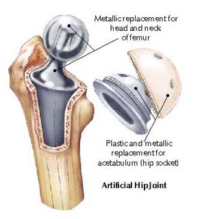 joint replacement