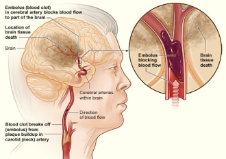 ischemic stroke